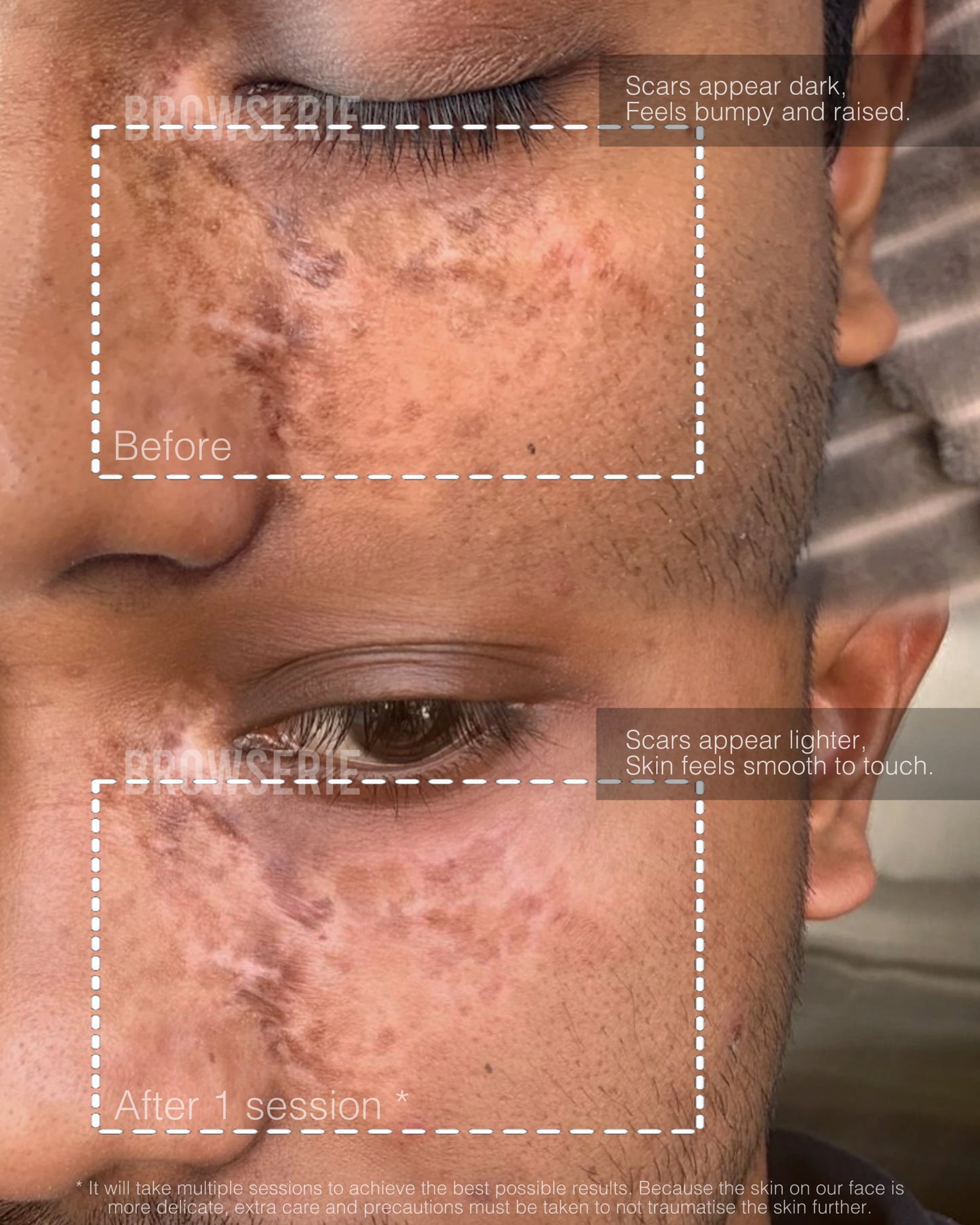 Paramedical Camouflage Tattoo (1 free touch up)