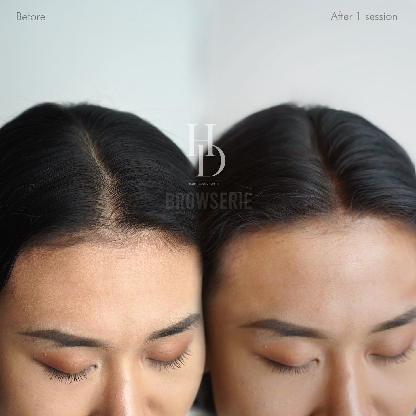 HD Scalp (4 sessions)