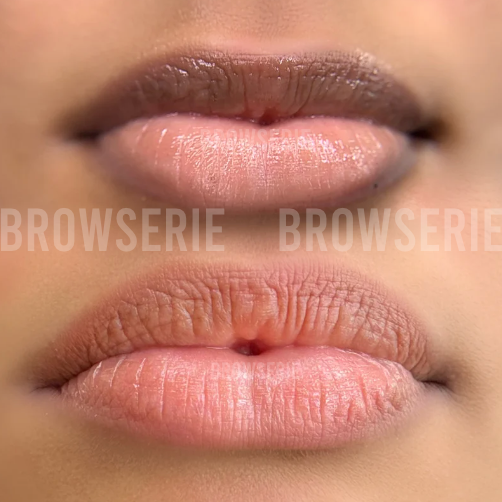 Dark Lip Neutralisation Course