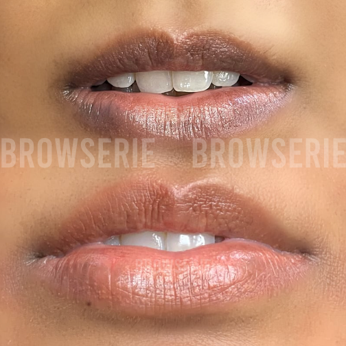 Dark Lip Neutralisation Course