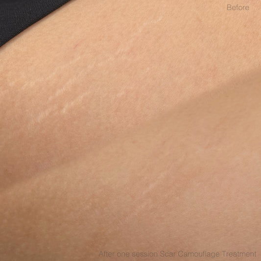 Paramedical Camouflage Tattoo (1 free touch up)