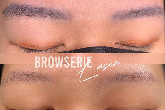 Brow Laser Tattoo Removal