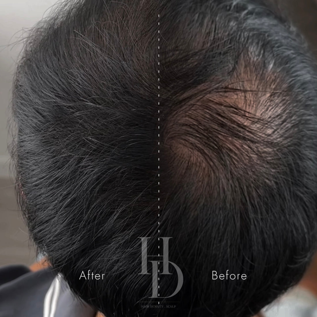 Scalp Micropigmentation (SMP)