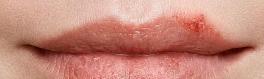 Cold Sore After Lip Blush: What to Do?