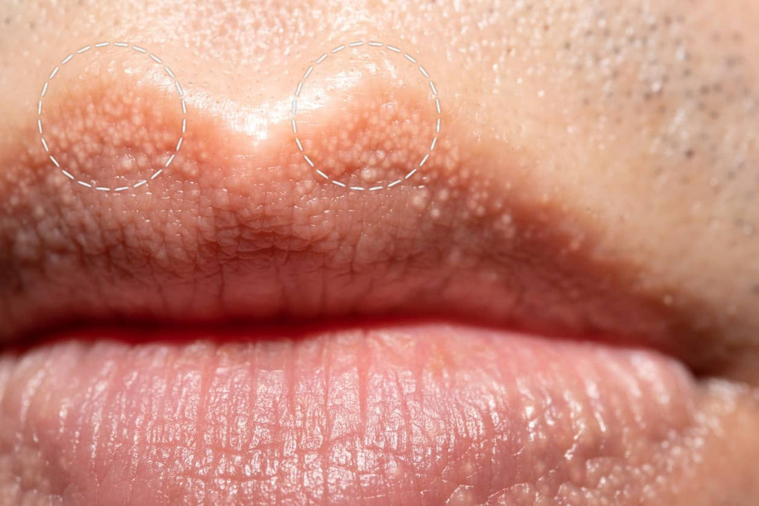 What Are Fordyce Spots and How Can Lip Blush Help?