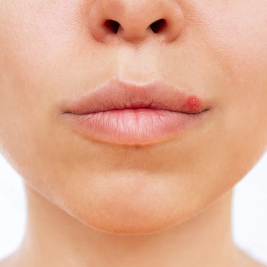 Cold Sore After Lip Blush: What to Do?