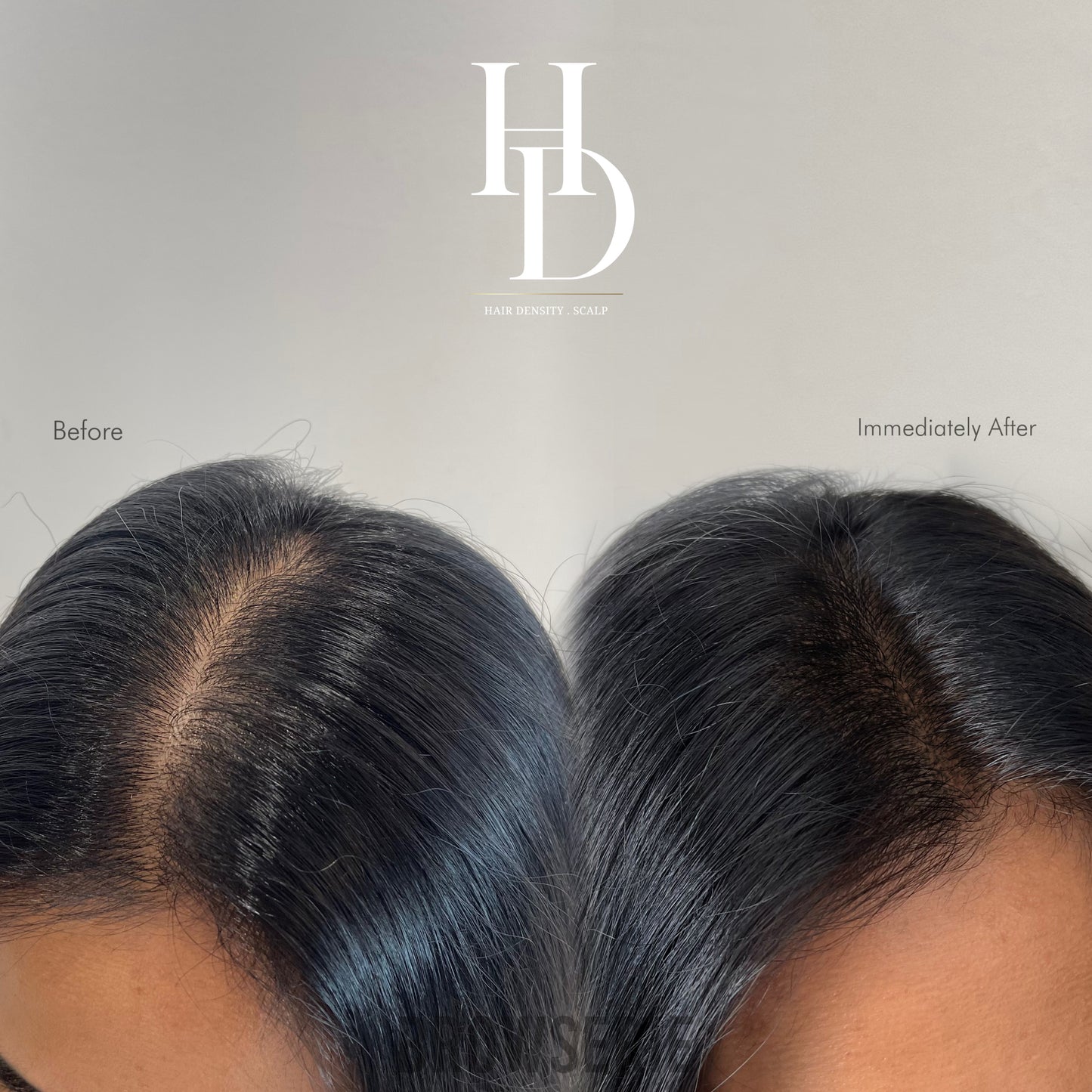 HD Scalp (4 sessions)