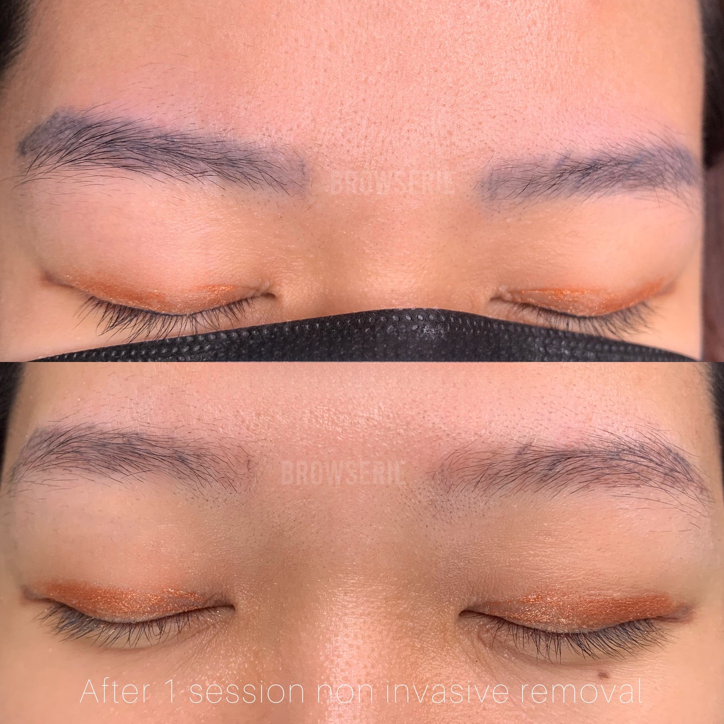 Laser Removal (Unlimited sessions) + New Brows (2 sessions) Package