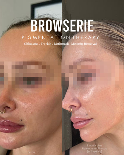 Permanent Pigmentation Removal