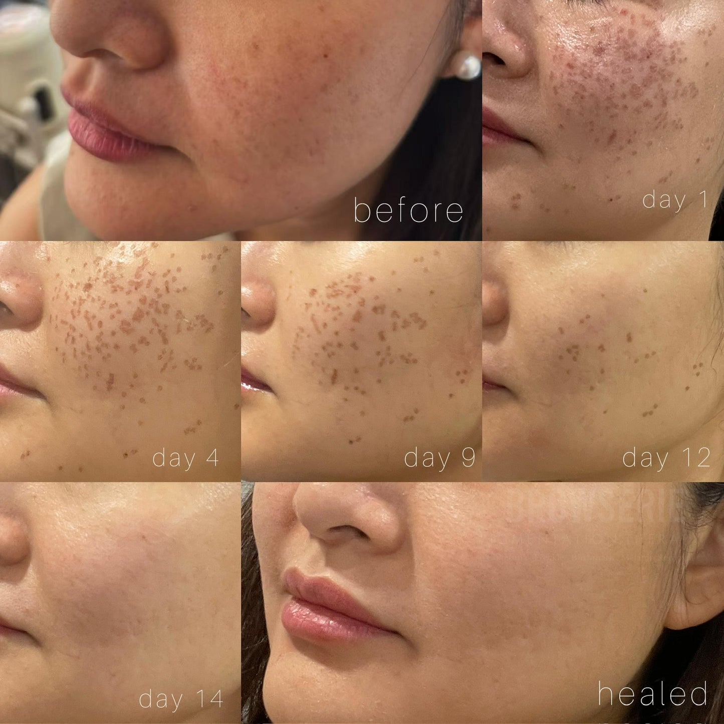 Permanent Pigmentation Removal