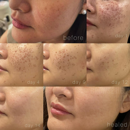 Permanent Pigmentation Removal
