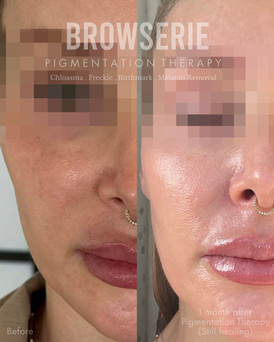 Permanent Pigmentation Removal