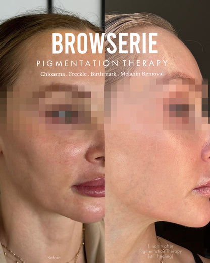 Permanent Pigmentation Removal
