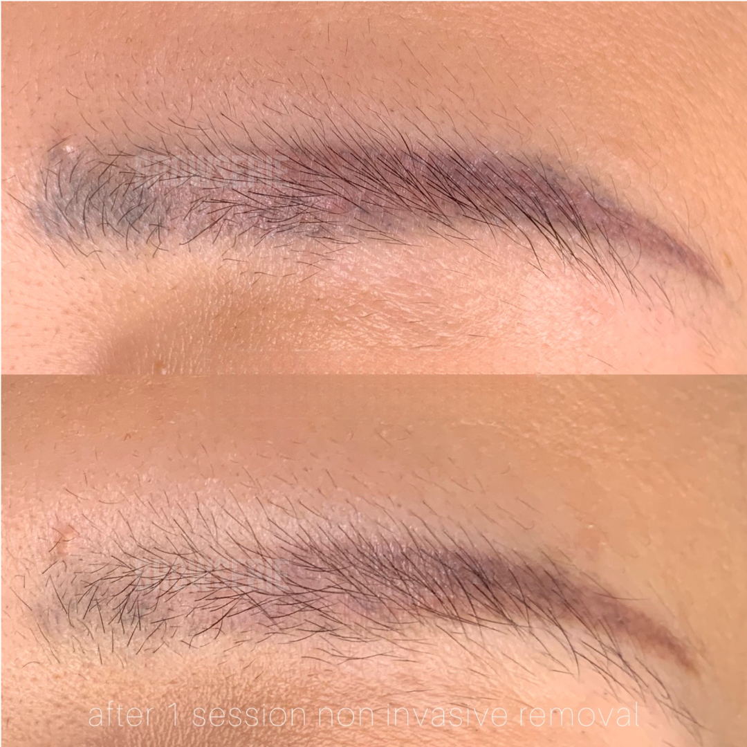 Laser Removal (Unlimited sessions) + New Brows (2 sessions) Package