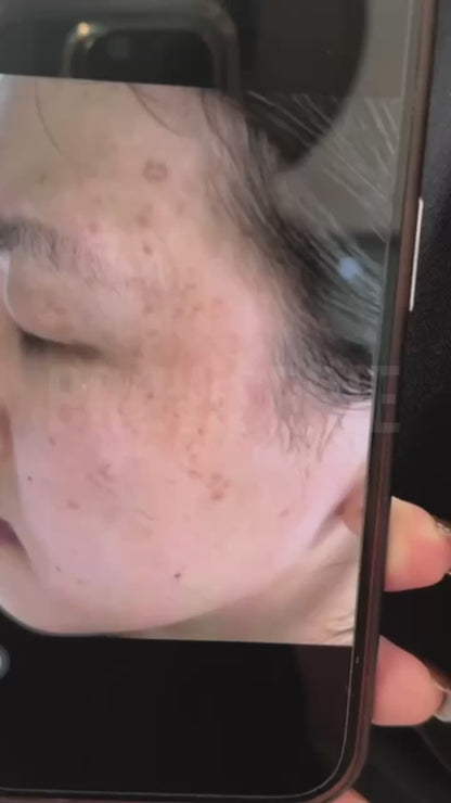 Permanent Pigmentation Removal