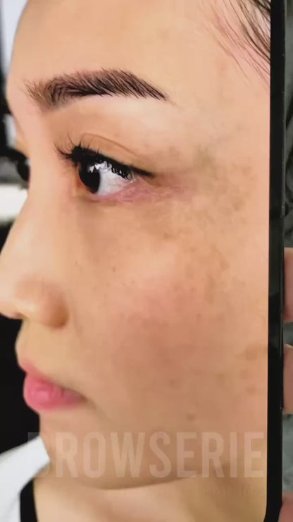 Permanent Pigmentation Removal