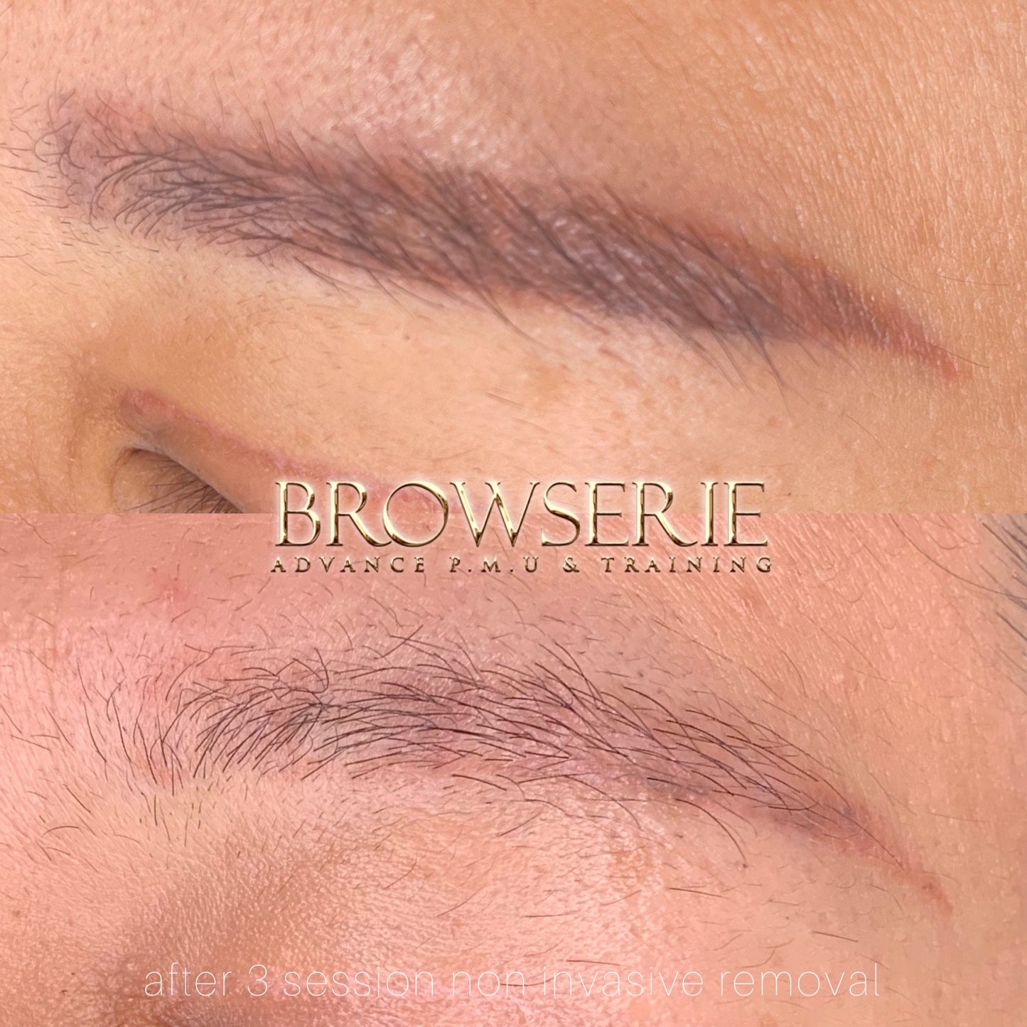 Laser Removal (Unlimited sessions) + New Brows (2 sessions) Package
